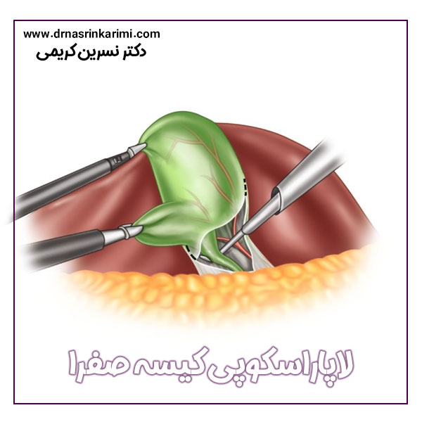 لاپاراسکوپی کیسه صفرا + دکتر نسرین کریمی