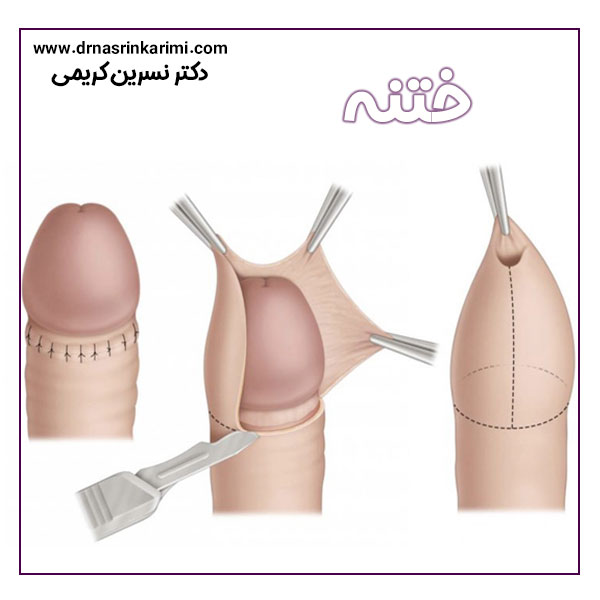 ختنه در کرمانشاه + دکتر نسرین کریمی