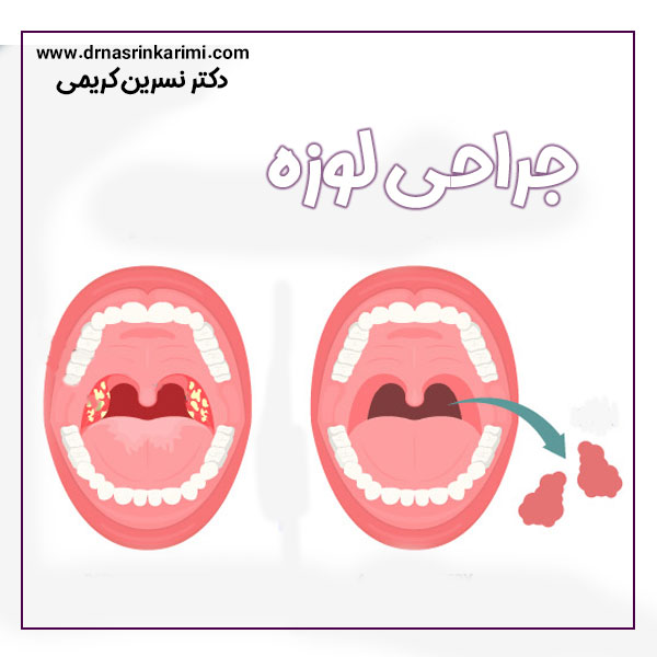 جراحی لوزه در کرمانشاه + دکتر نسرین کریمی