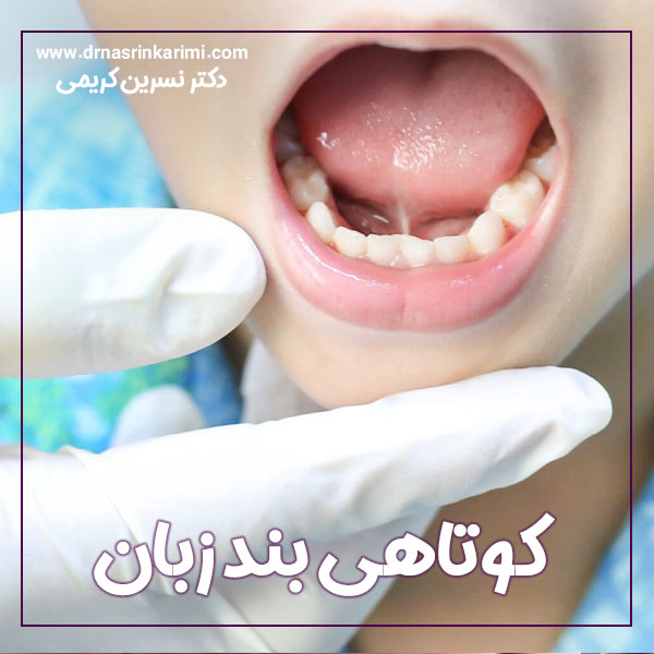 کوتاهی بند زبان + دکتر نسرین کریمی