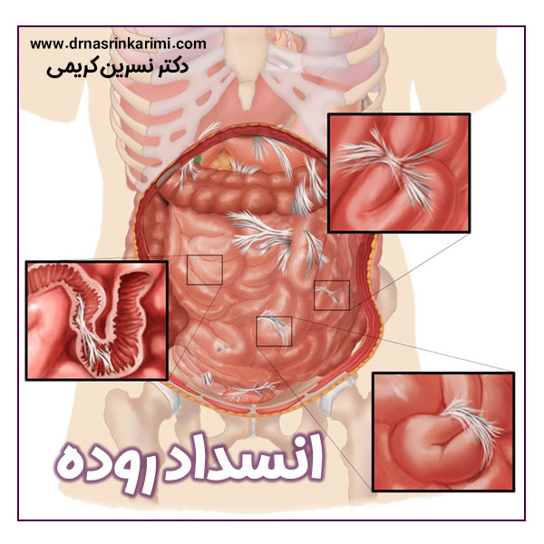 انسداد روده + دکتر نسرین کریمی در کرمانشاه