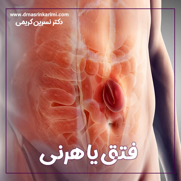 درمان فتق در کرمانشاه | دکتر نسرین کریمی
