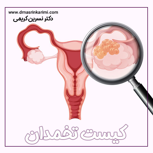 کیست تخمدان + دکتر نسرین کریمی
