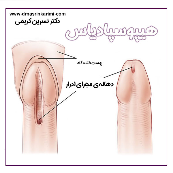 هیپوسپادیاس در کرمانشاه + دکتر نسرین کریمی