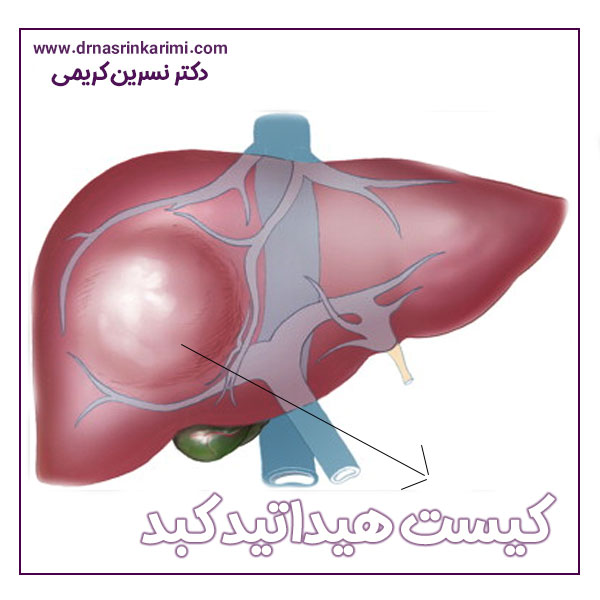 کیست هیداتید کبد + دکتر نسرین کریمی