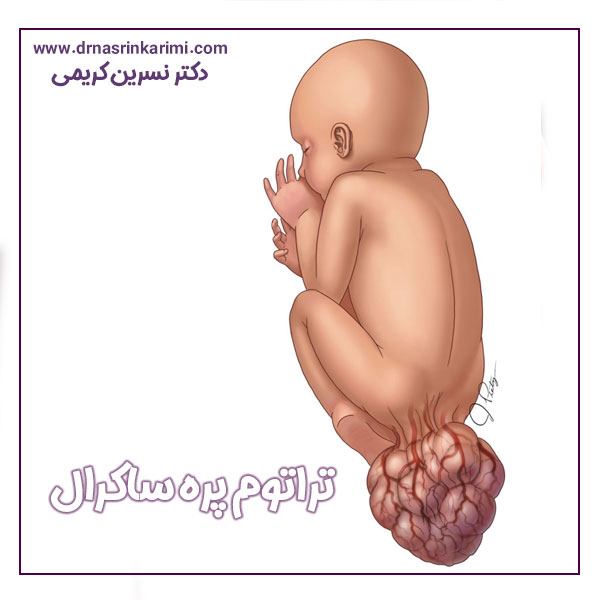 تراتوم پره ‌ساکرال + دکتر نسرین کریمی