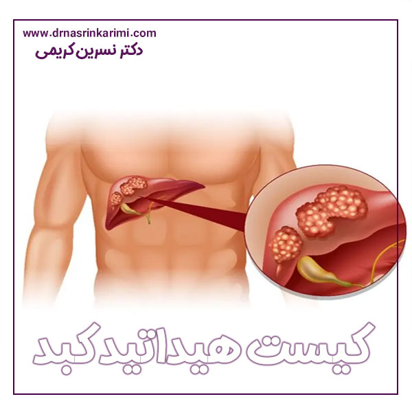 کیست هیداتید کبد + دکتر نسرین کریمی