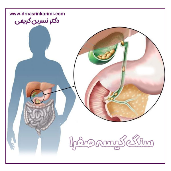 سنگ کیسه صفرا + دکتر نسرین کریمی