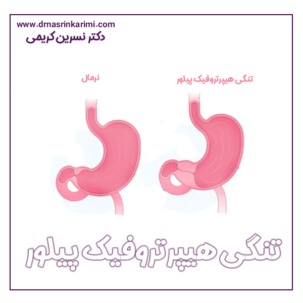 تنگی هیپرتروفیک پیلور + دکتر نسرین کریمی