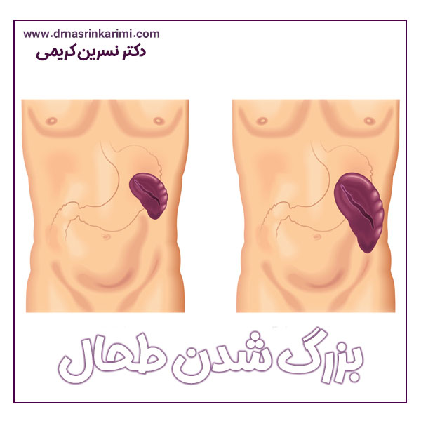 بزرگ شدن طحال + دکتر نسرین کریمی