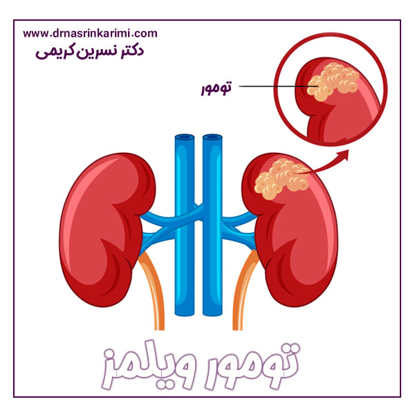 تومور ویلمز + دکتر نسرین کریمی